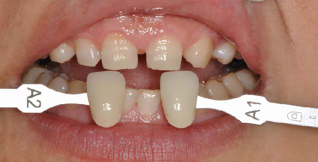牙缝大怎么办？看看圣贝口腔专业的修复流程再决定！！！